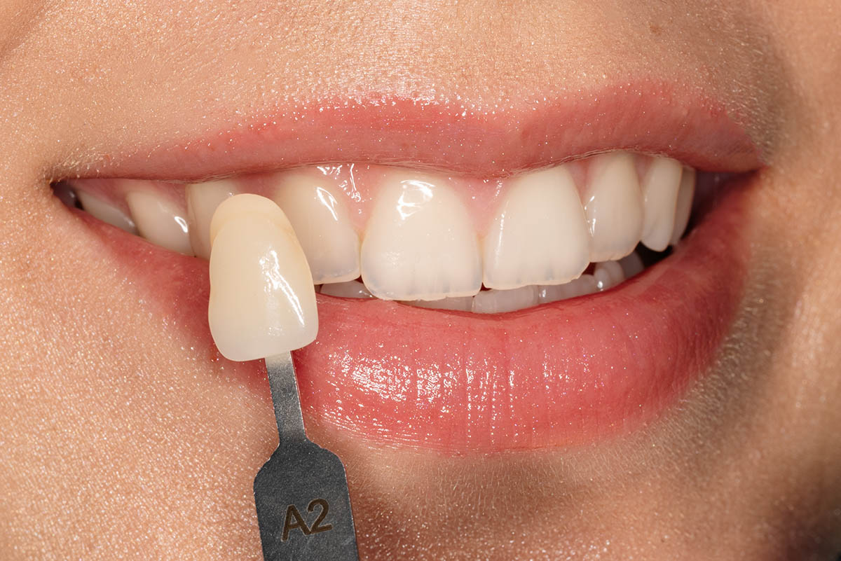 Licówki Poznań, estetyczna stomatologia